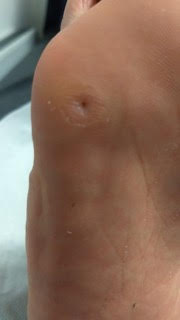 An after photo of corn removal by podiatrist Beth Fechner at The Foot Alignment Clinic
