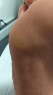 A before photos of corn removal